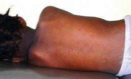 Le ministère Sierra Léonais de la Santé annonce une épidémie de rougeole