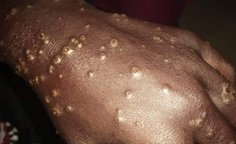 Le Dr Diambogne Ndour s’explique sur les multiples cas de dermatoses apparus chez des pêcheurs sénégalais