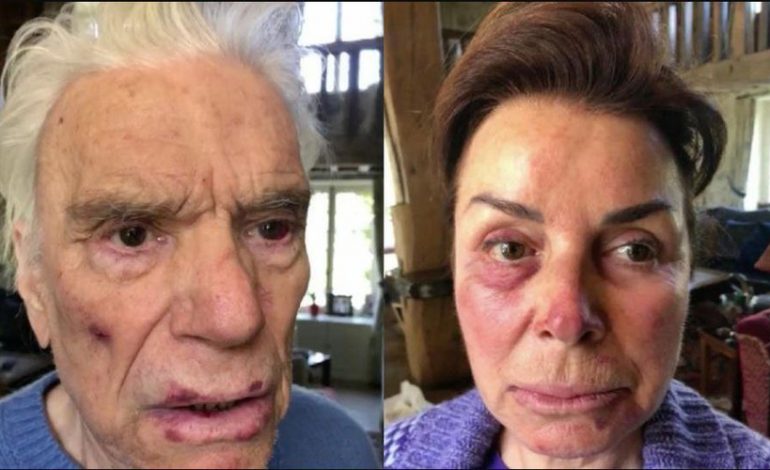 Les photos chocs de Bernard Tapie et son épouse après leur sauvage agression ce week-end