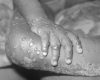 De nouveaux cas de variole du singe recensés chaque jour au Royaume-Uni
