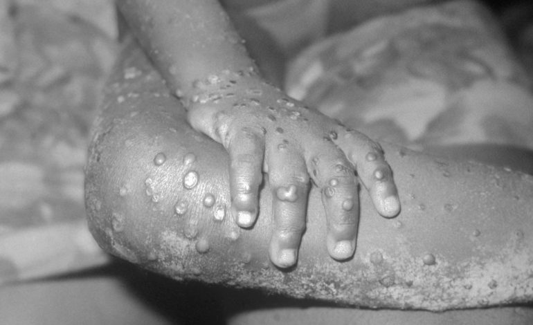 Plus de 200 cas de variole du singe confirmés dans le monde